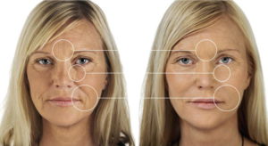 Facial Filler Special Offer