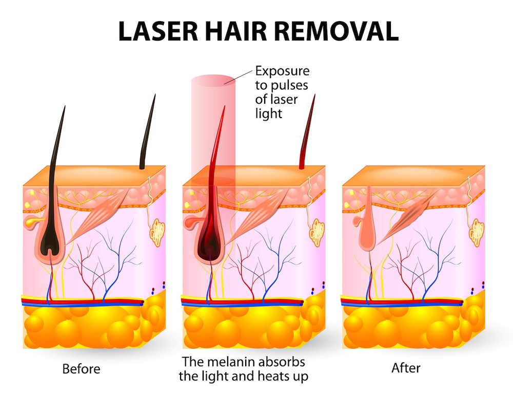 Laser Hair Removal Made Easy and Affordable. Be Hair Free This Summer